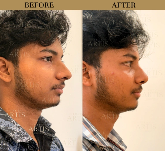 Before After
