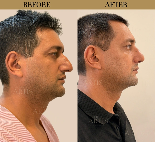 Before After
