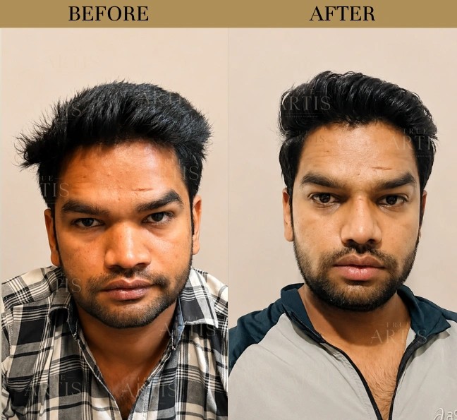 Before After