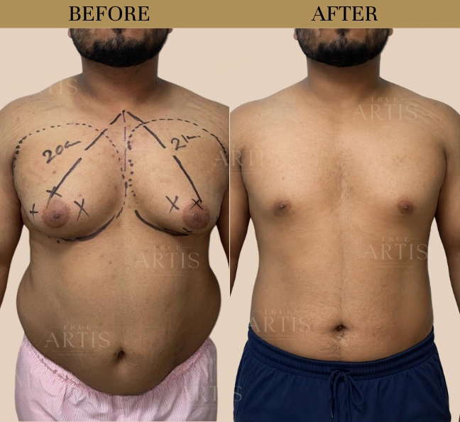 Before After