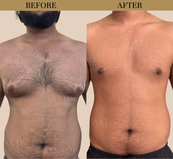 Before After