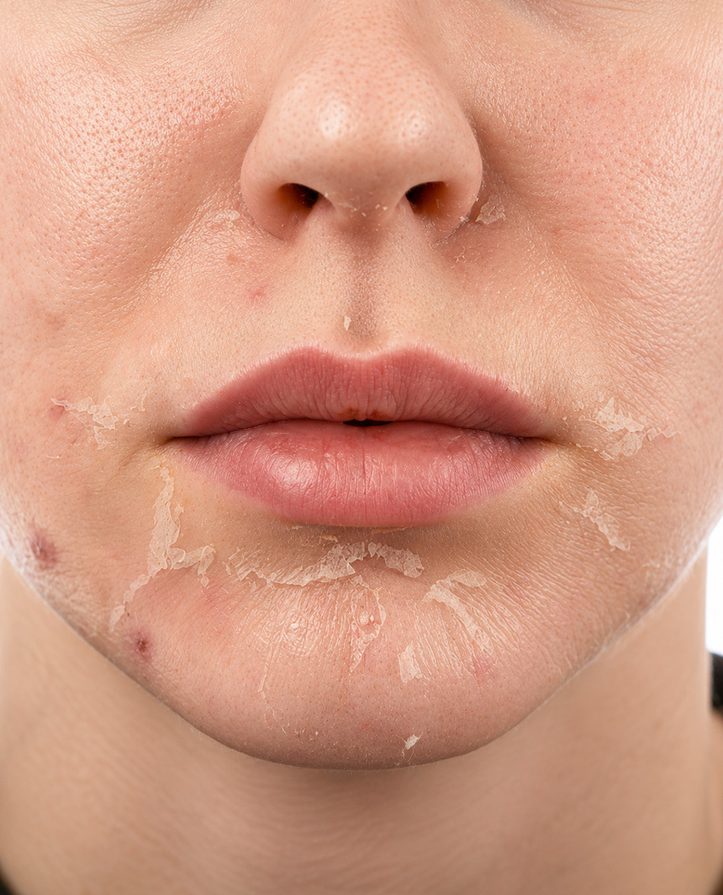 How is the chemical peel treatment performed?
