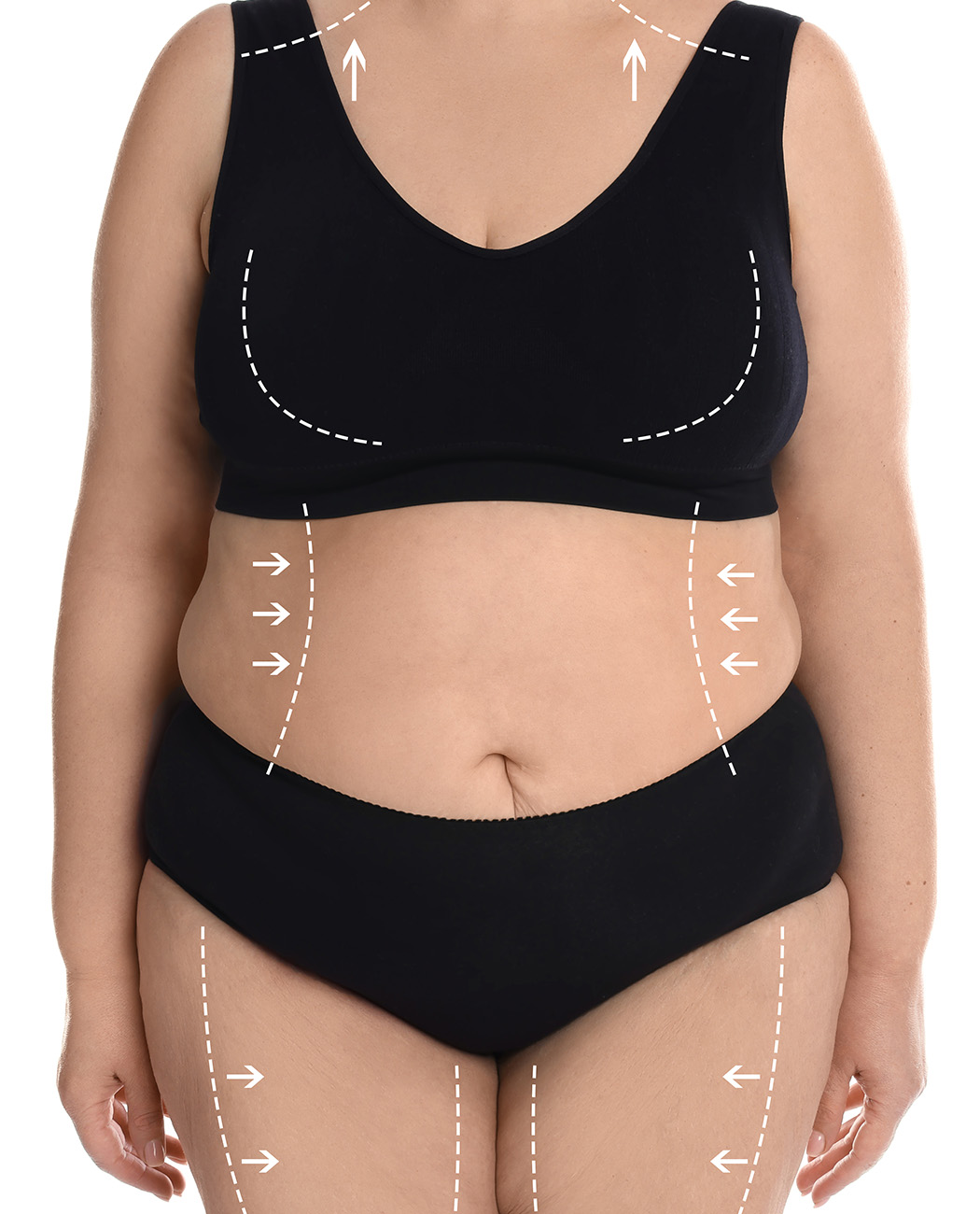 What is Post-Bariatric Body Lift?