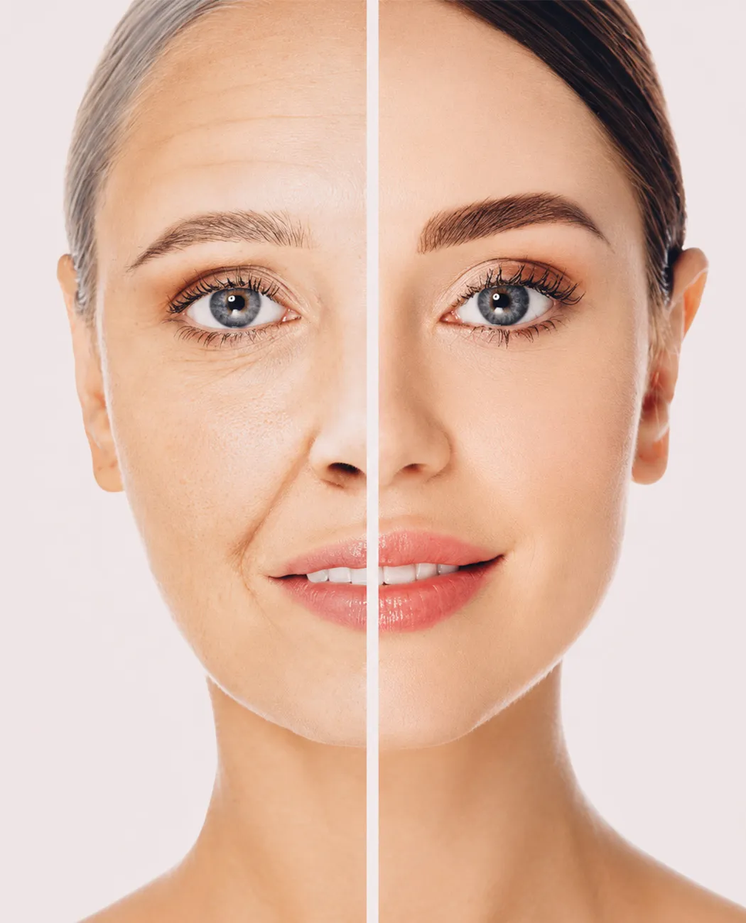 How is Dermal Filler Treatment Performed?