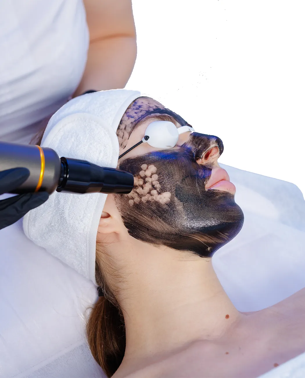 What is Carbon Laser Peel Treatment?