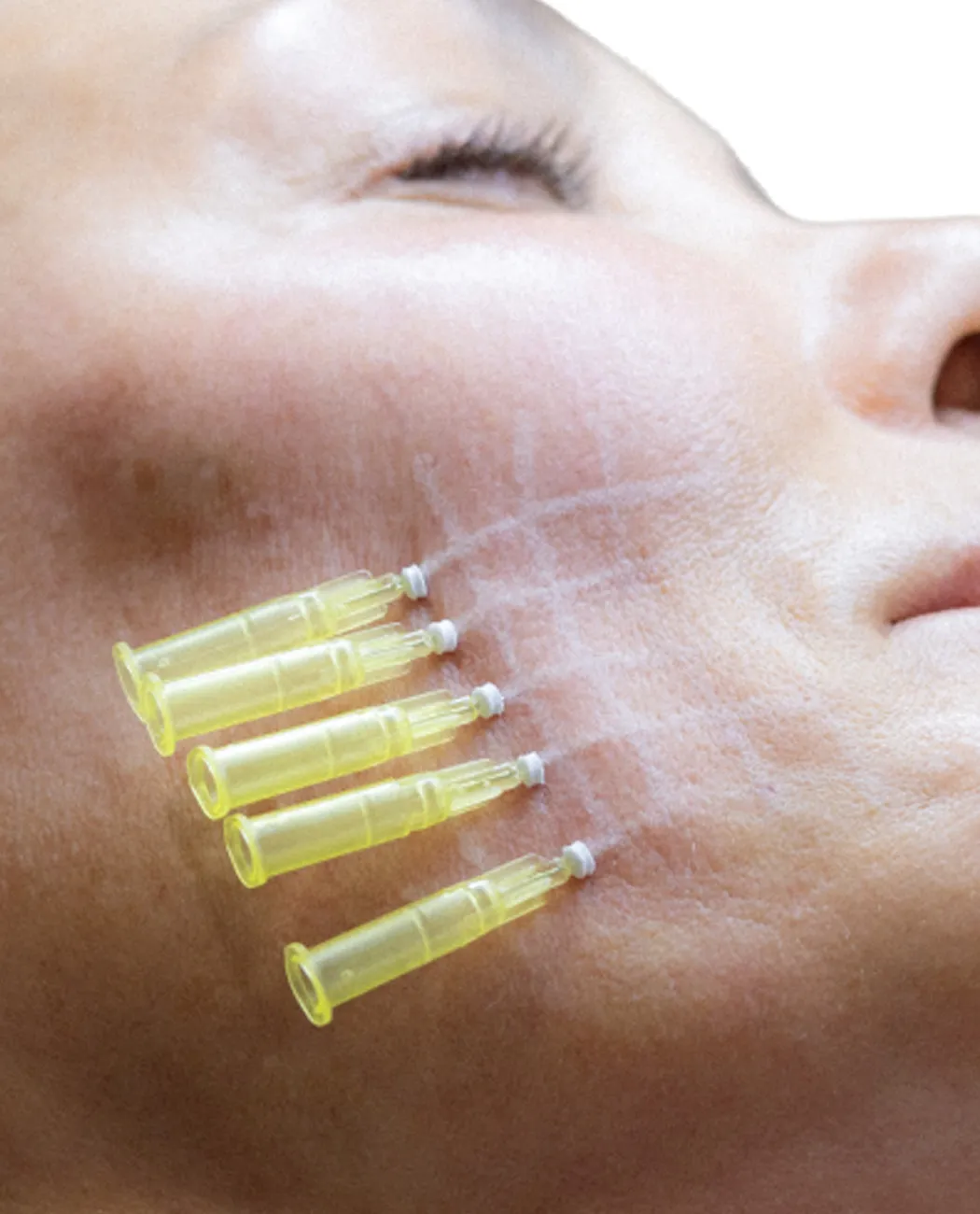 How is Thread Lift surgery performed?