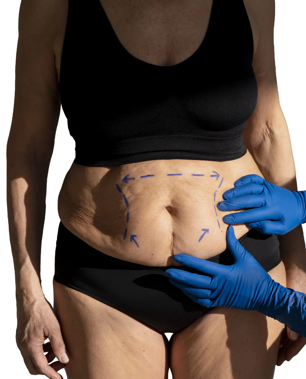 What is Tummy Tuck Surgery?