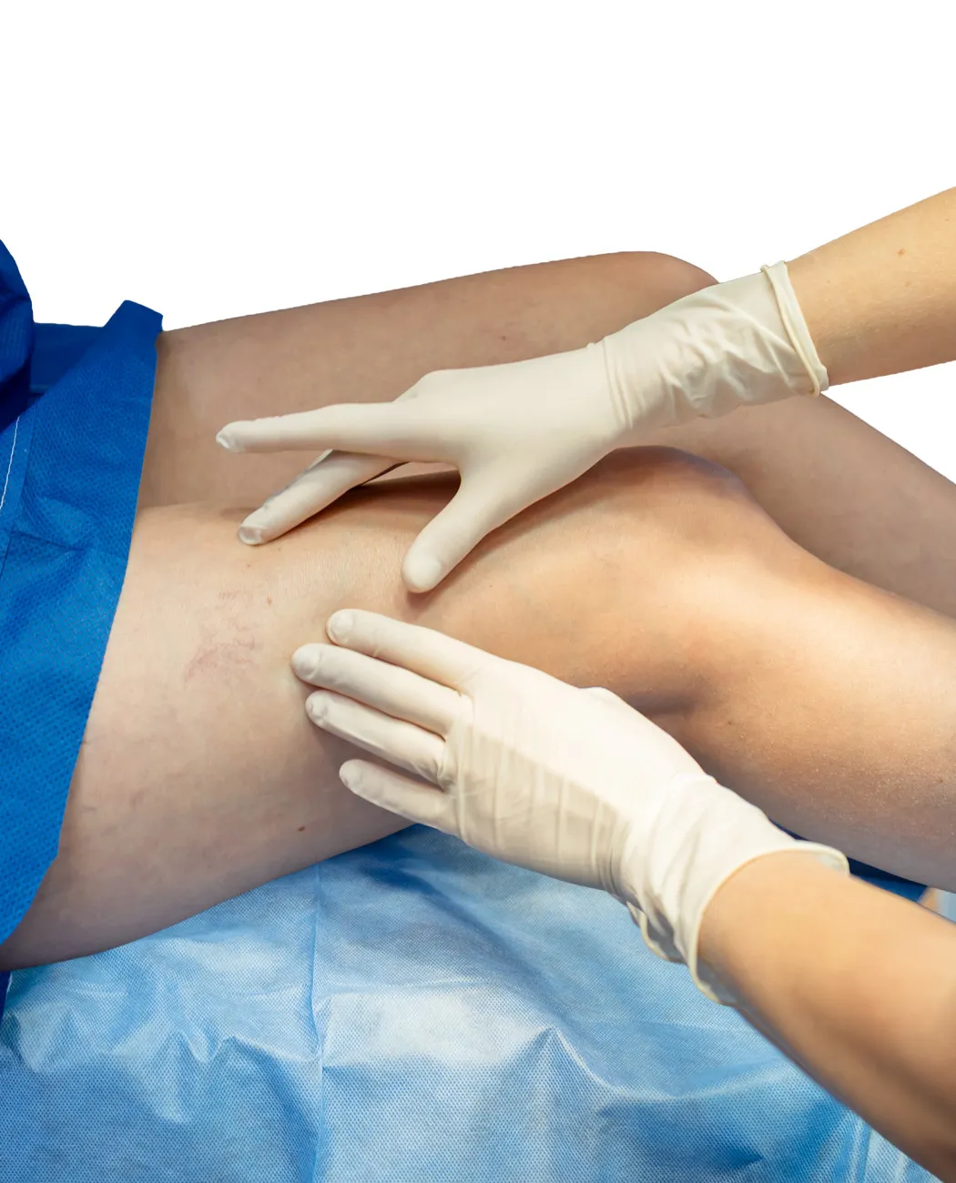 How is Thigh Lift Surgery Performed?