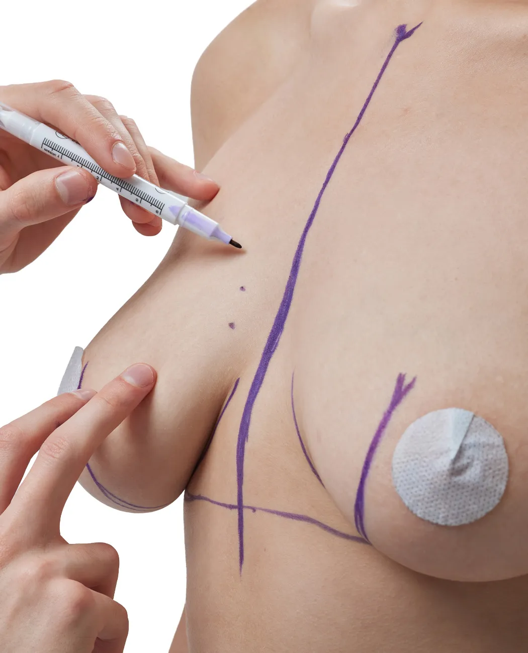 Who is an Ideal Candidate for Breast Lift Surgery?